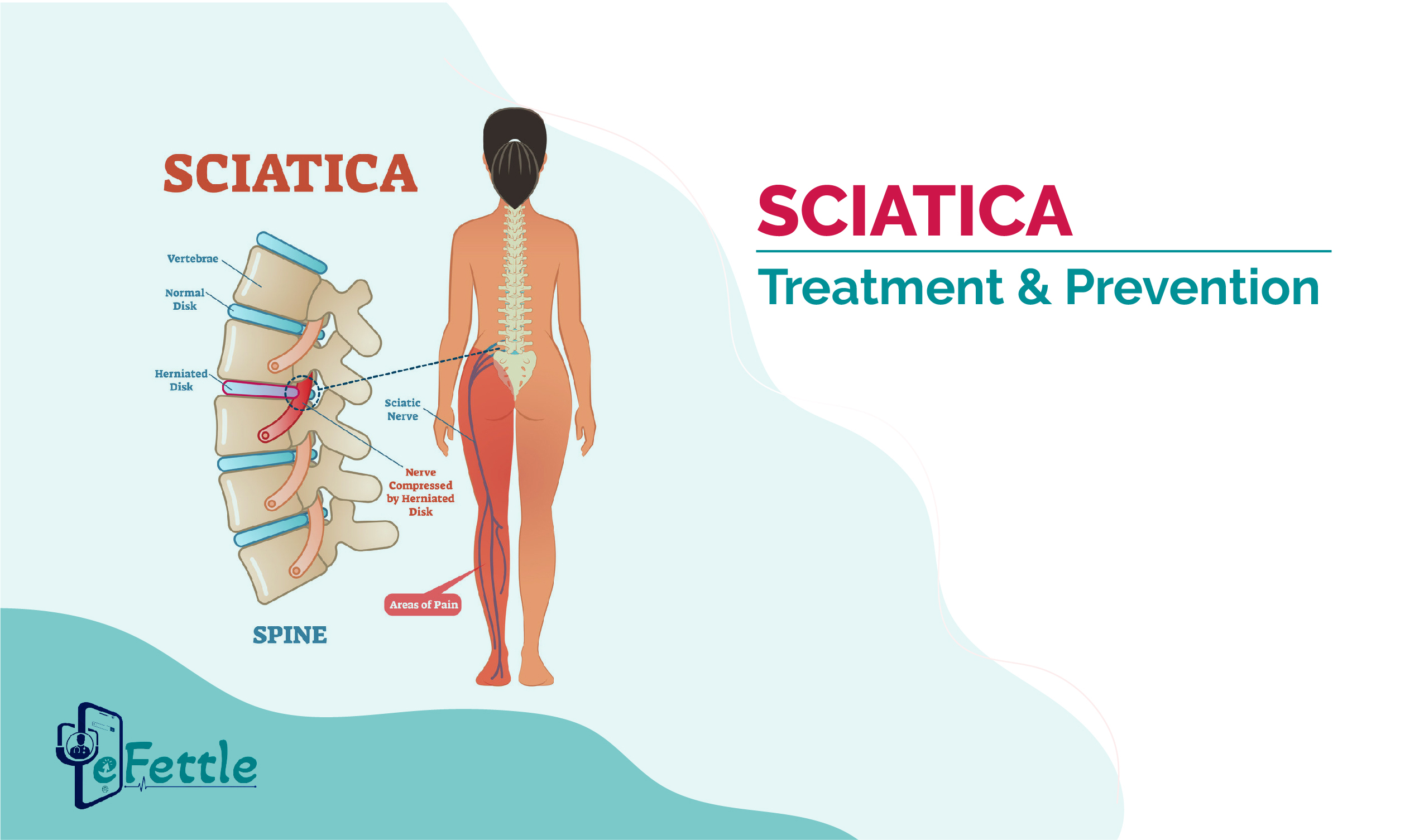 SCIATICA