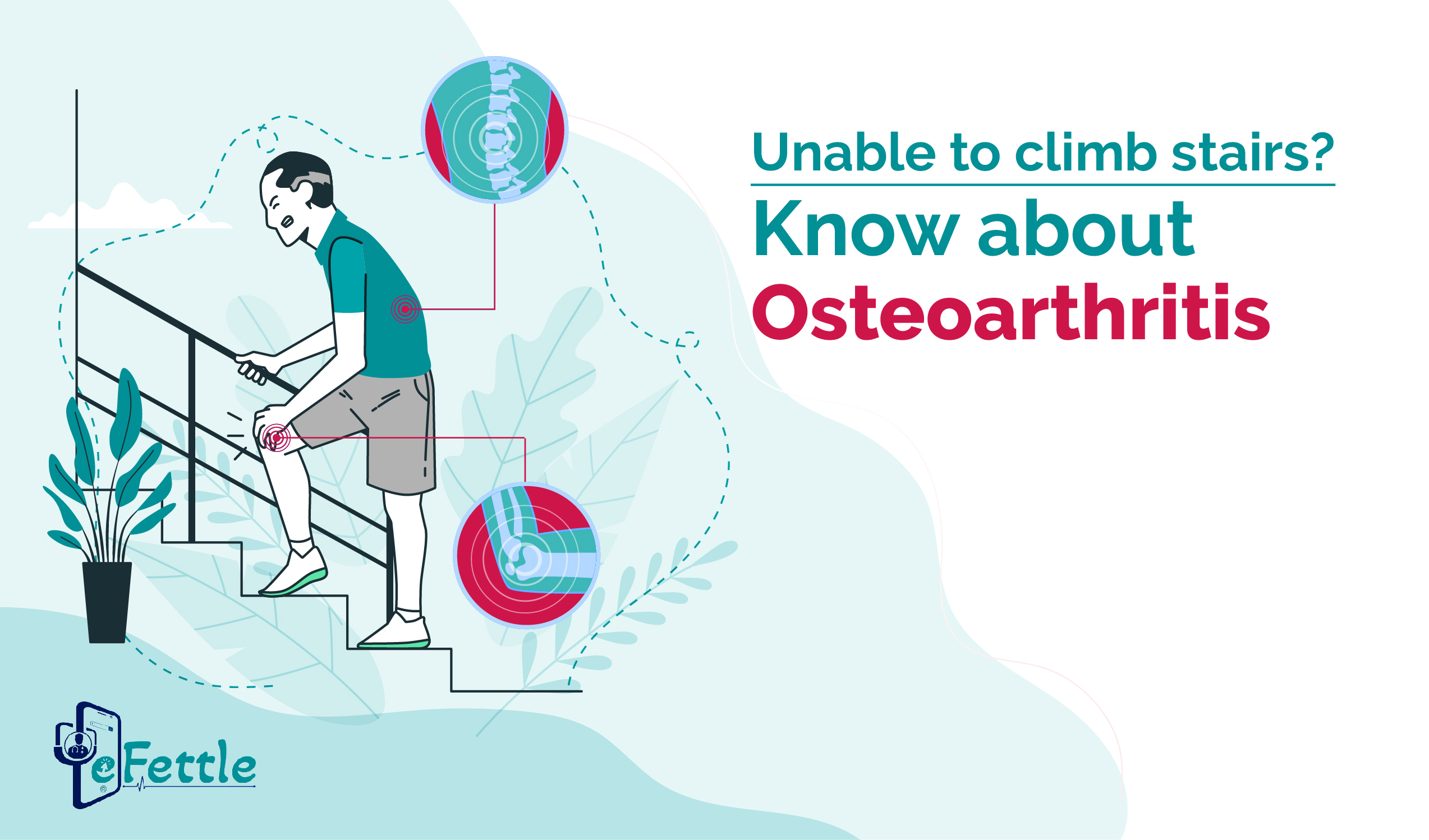 Unable to climb stairs Know about Osteoarthritis