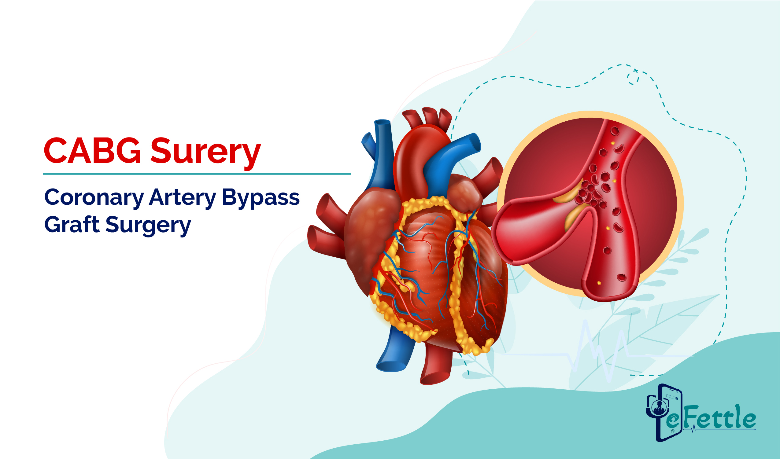 CABG Surgery