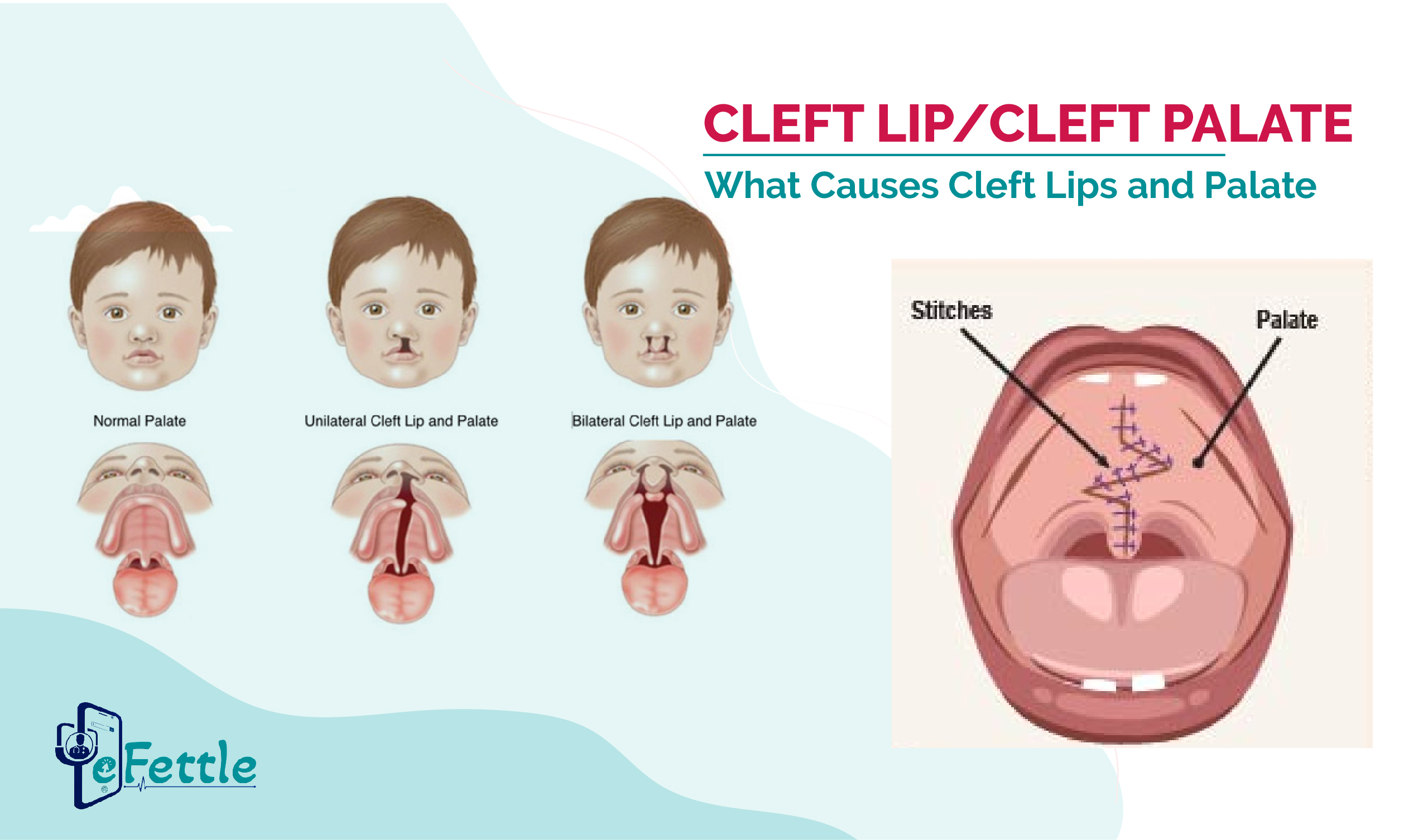 CLEFT LIP & PALATE